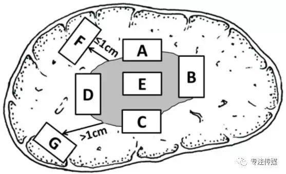 csco原发性肝癌诊疗指南解读,原发性肝癌规范治疗
