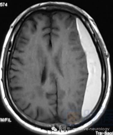 脑出血磁共振t1t2表现,10分钟记住脑出血核磁表现