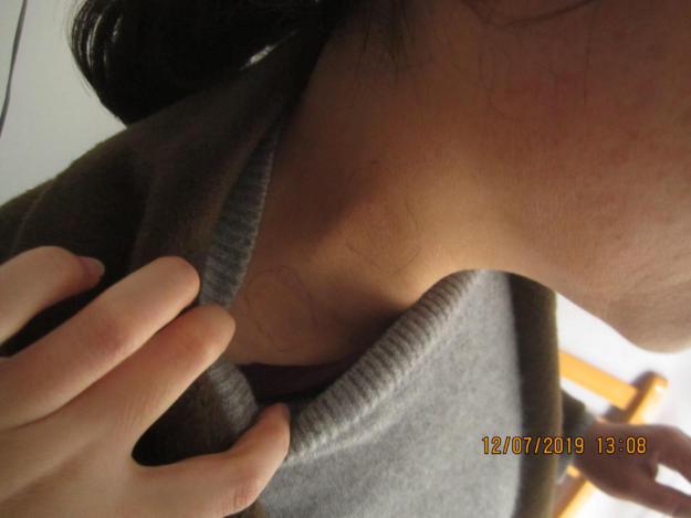 从确诊到康复，仅4个月，颈部白癜风患者王女士分享成功经验