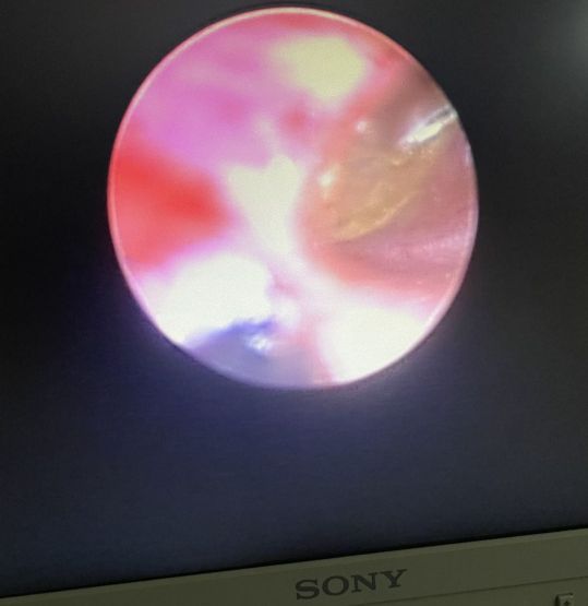 我的一次看病经历,艾灸治疗中耳炎真实经历