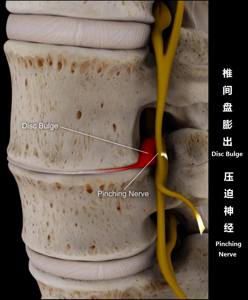上班族该怎么预防腰痛,腰痛要警惕四种原因及治疗方法