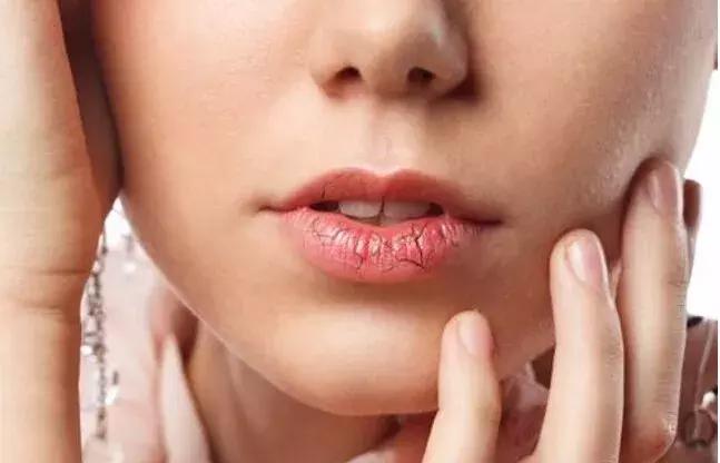 大s去唇干裂小妙招,嘴唇干裂起皮小秘方