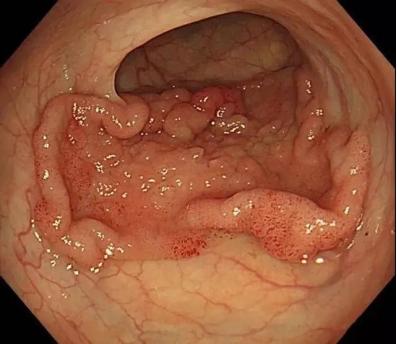 得了低位直肠癌，到底该做哪一种保肛手术？