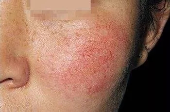 去红血丝最快最有效的方法,去红血丝最好的方法最快