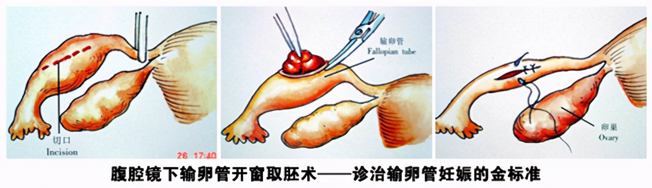 宫外孕切除输卵管会有什么后遗症,宫外孕为什么医生建议输卵管切除