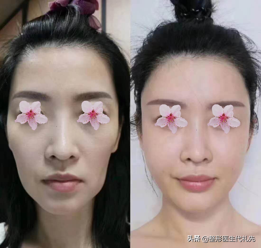 面部松弛提拉最好的方法,面部松弛下垂最好的提拉手术