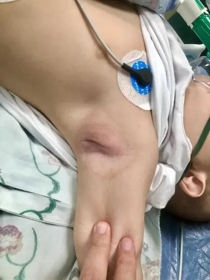 9个月宝宝发烧咳嗽半个月,腋下长了个“鹌鹑蛋”,医生说:这个病不简单
