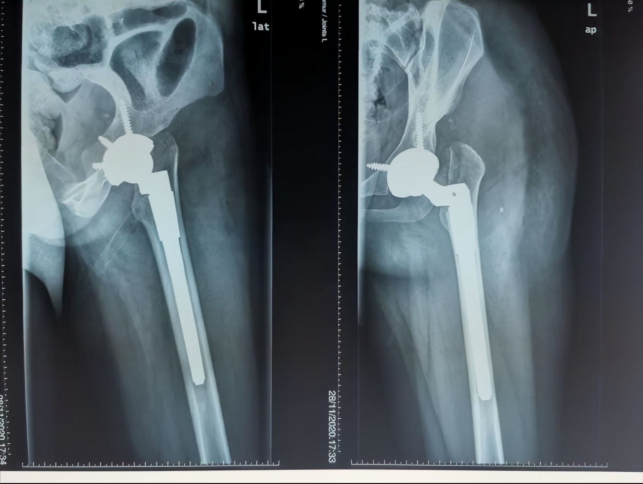 AI助力精准处理IV型髋关节发育不良花季少女翻开人生新篇章