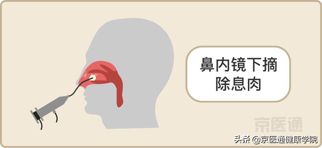 升结肠0.4息肉是癌的可能性是多少,胃体多发息肉0.2-0.4是癌吗