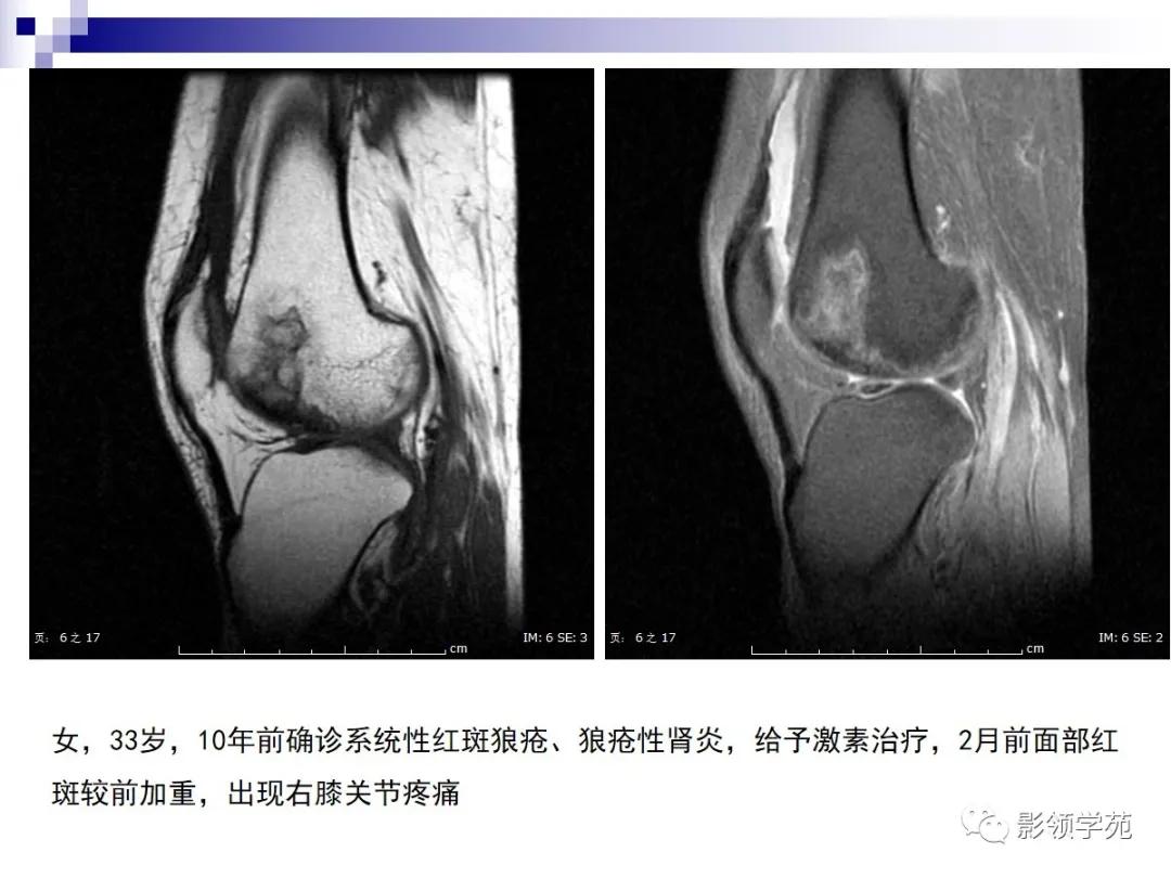 早期骨梗死的ct表现,骨梗死的病理变化