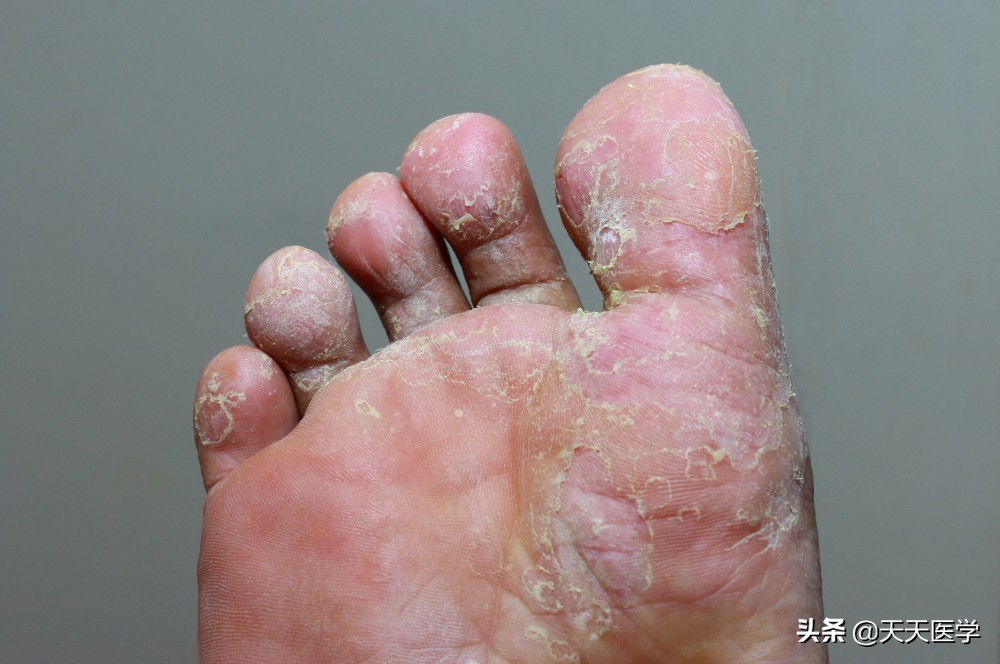 脚气的危害和注意事项,脚气的注意事项及治疗误区