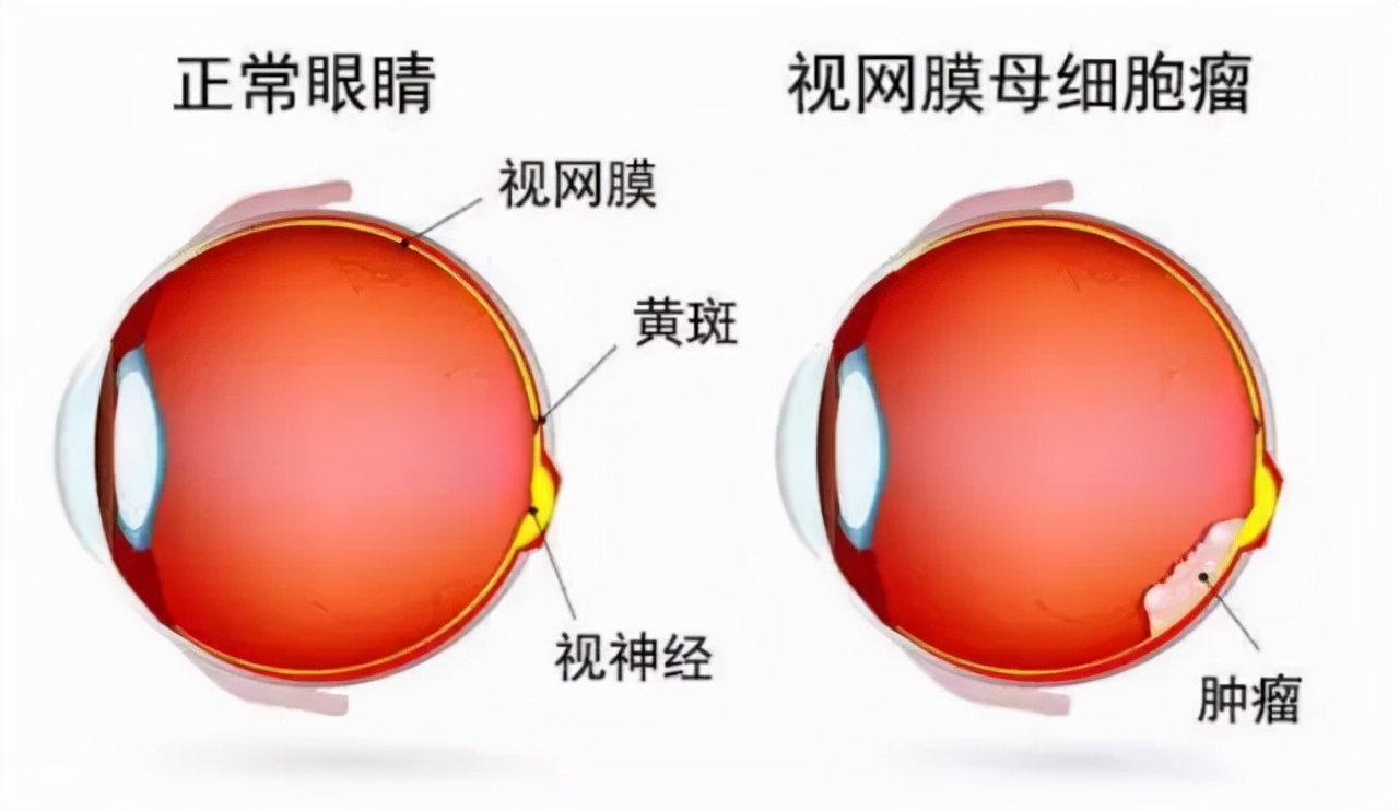 咸阳市第一人民医院晶体植入手术,咸阳第一人民医院近视眼手术