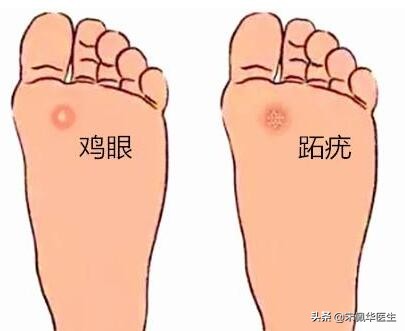 如何区分跖疣和鸡眼,怎么分辨跖疣和鸡眼