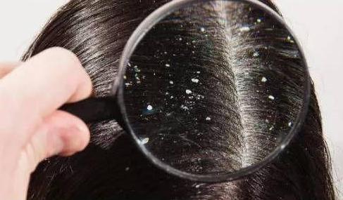 头发出油痒头皮屑多怎么办,头发出油头皮屑痒用什么洗发水