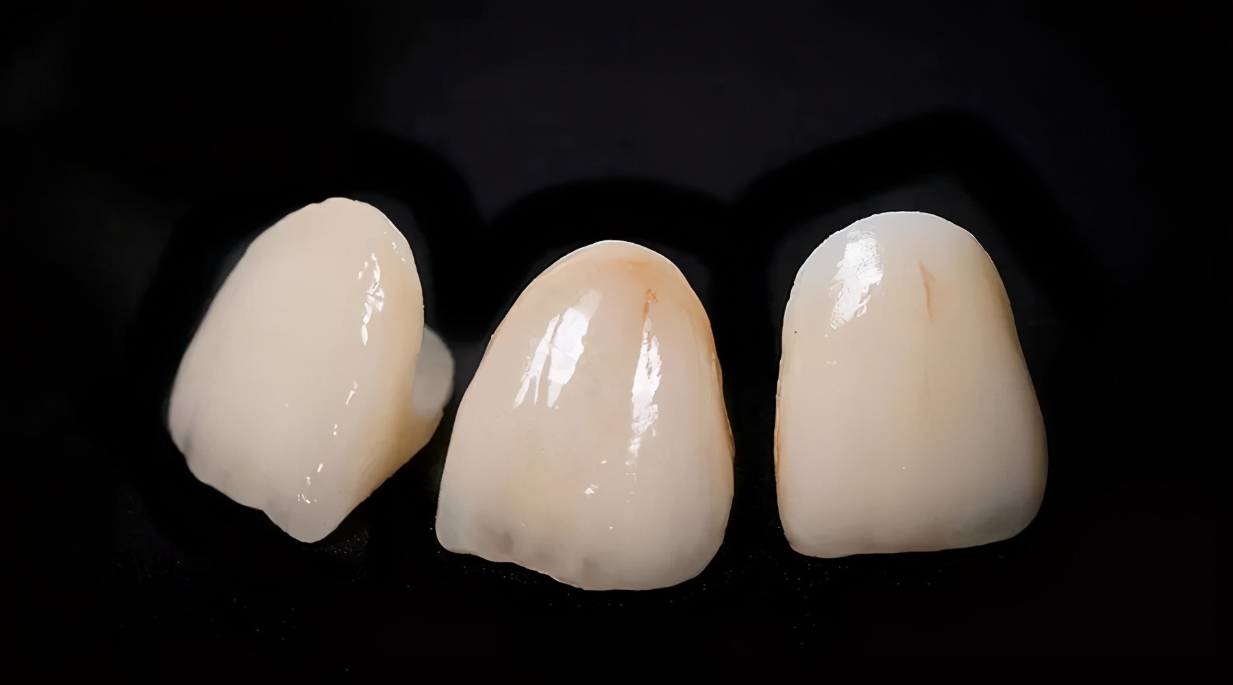 除了矫正牙齿还有其他方法吗,除了牙套还有什么方法矫正