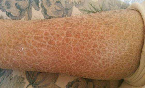 天气干燥腿上起皮怎么办,脚后跟干裂腿上有鱼鳞