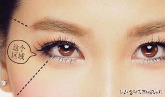 自体脂肪丰太阳穴多久才能恢复,自体脂肪丰太阳穴多久恢复正常