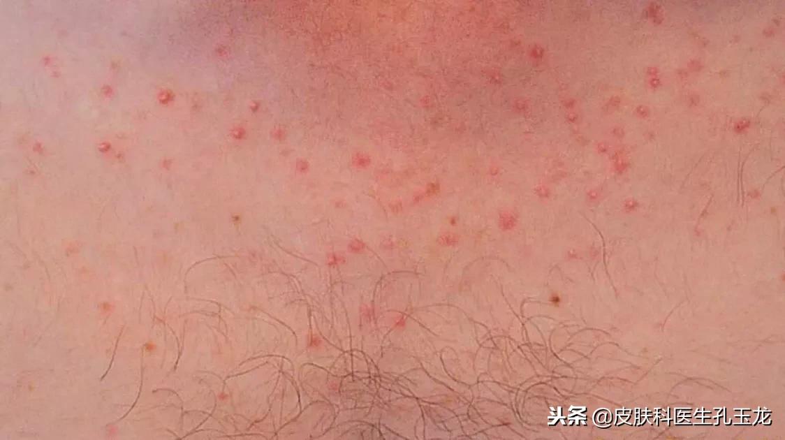 毛囊炎是不是小毛病,皮肤毛囊炎的原因和治疗方法