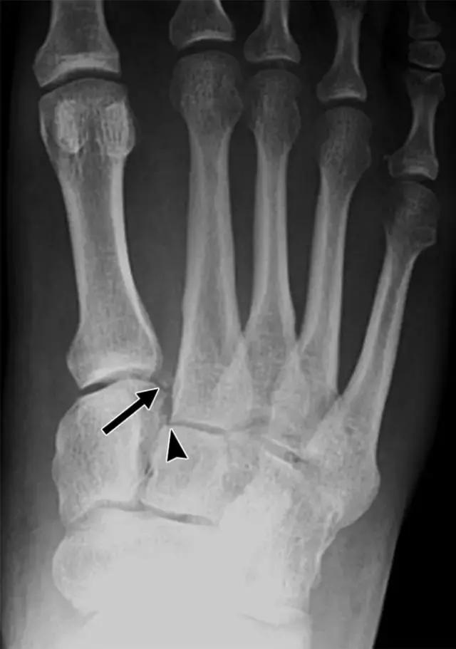 骨折处出现麻痹感,骨折跟精神状态有关