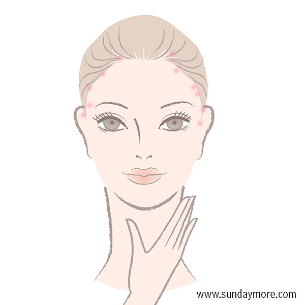 暗疮最好的消除方法 (暗疮印最佳治疗方法)