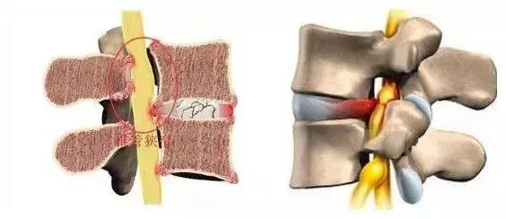 椎间盘突出和椎管狭窄症状的区别,腰椎管狭窄症的症状