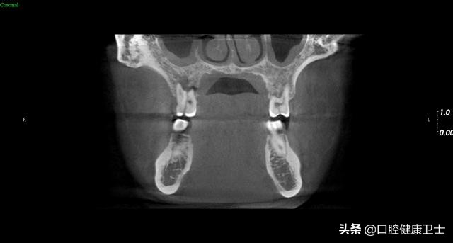 牙齿劈裂怎么处理,牙齿劈裂的补救方法