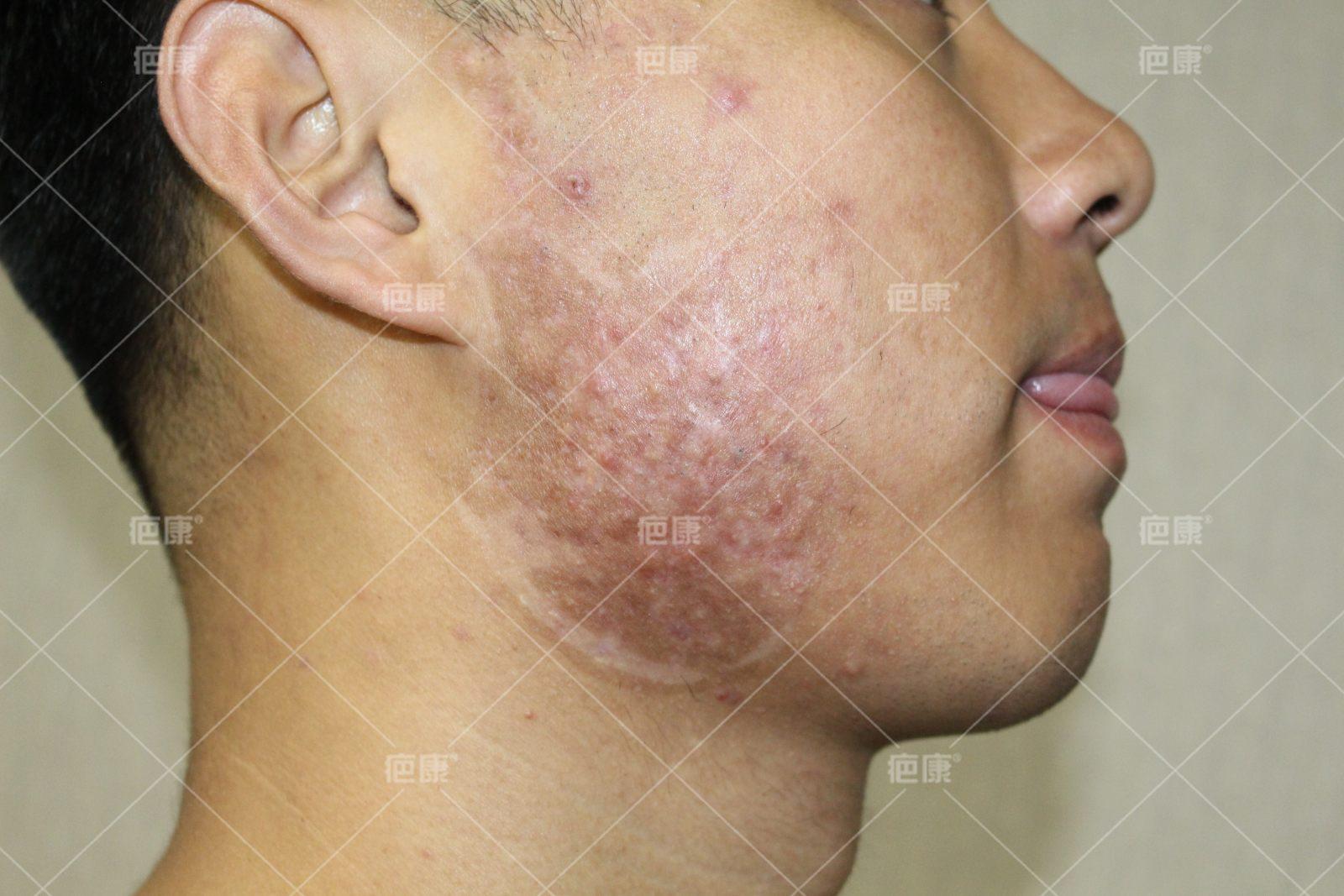 北京疤康治疤痕疙瘩怎么样,疤康治疗疼吗