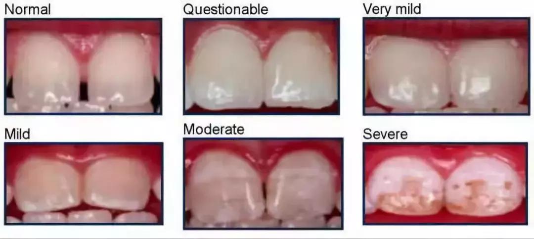儿童使用牙膏要注意什么,儿童错误刷牙导致牙齿损伤