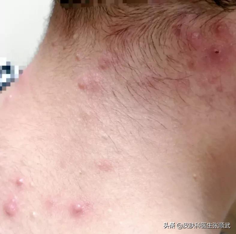 后脑勺毛囊炎疙瘩涂什么药,后脑勺耳朵位置长疙瘩毛囊炎