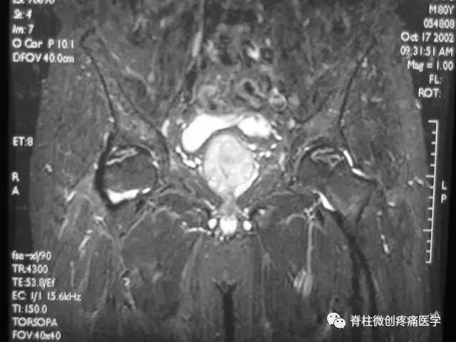 早期股骨头坏死核磁共振怎么看,股骨头坏死磁共振表现及分期