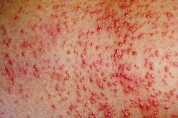 天气太热了宝宝长痱子怎么办,宝宝夏天痱子用什么方法消除最快