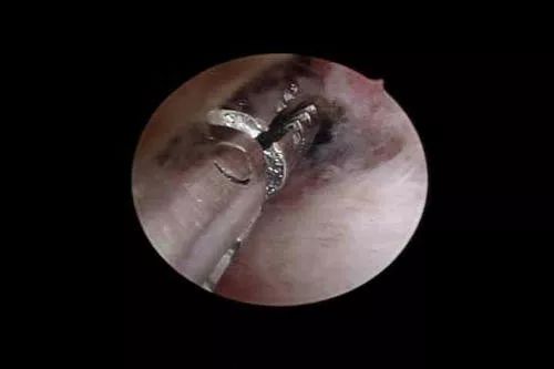 宫腔镜息肉切除术后注意事项,瘢痕妊娠宫腔镜术后注意事项