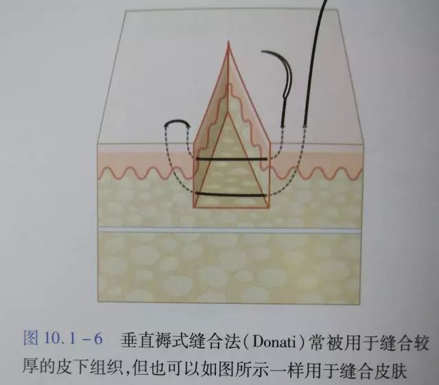 伤口闭合的正确方法,伤口清创的详细步骤
