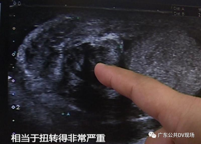 拖不起!男孩突然“蛋疼”不止,隔天送医被切除