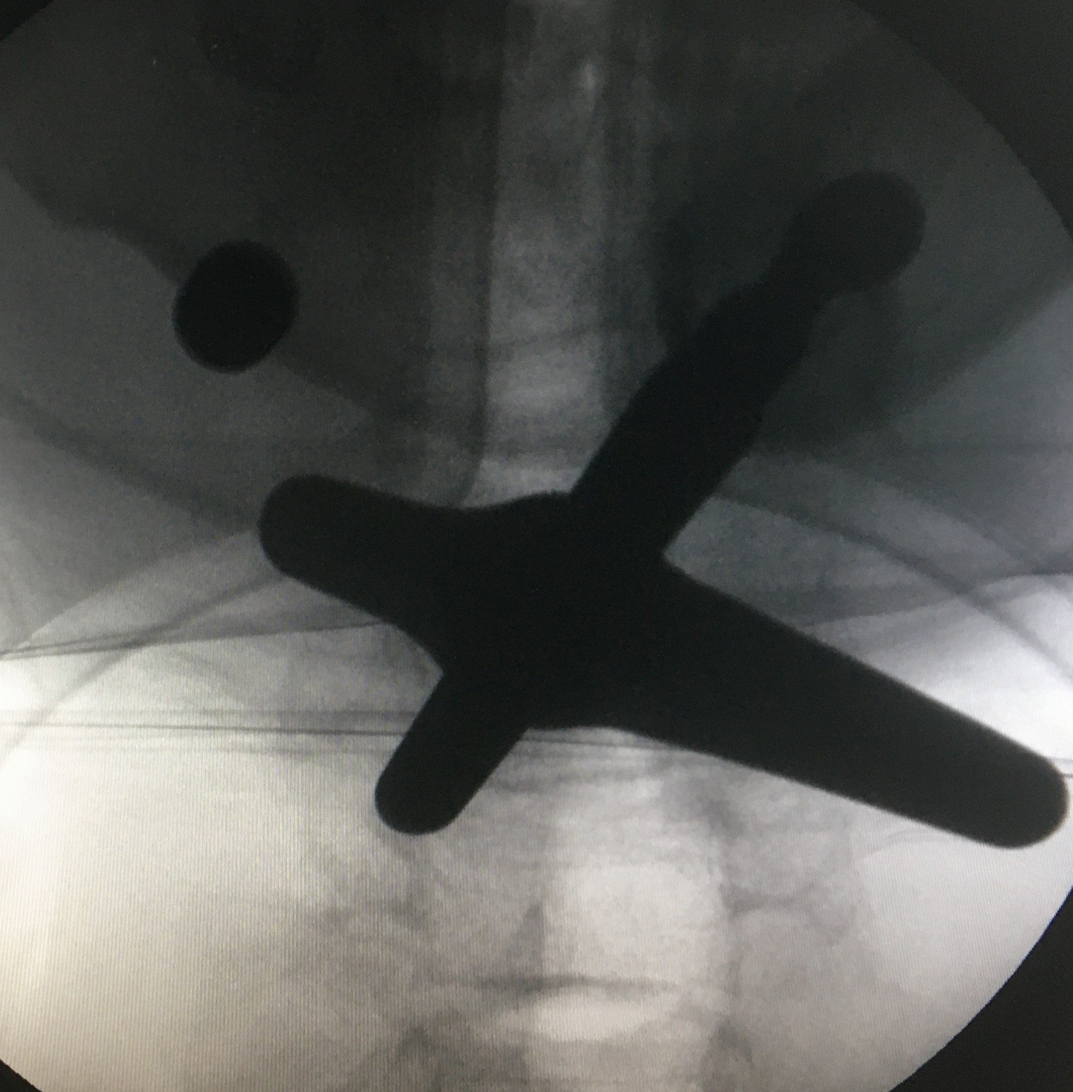 巨大颈椎间盘突出,疼痛日夜不宁,陈明博士微创孔镜后彻底康复