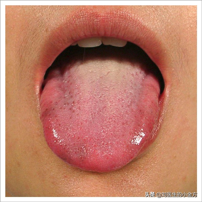 中医舌诊图解100例,中医舌诊图与舌诊口诀