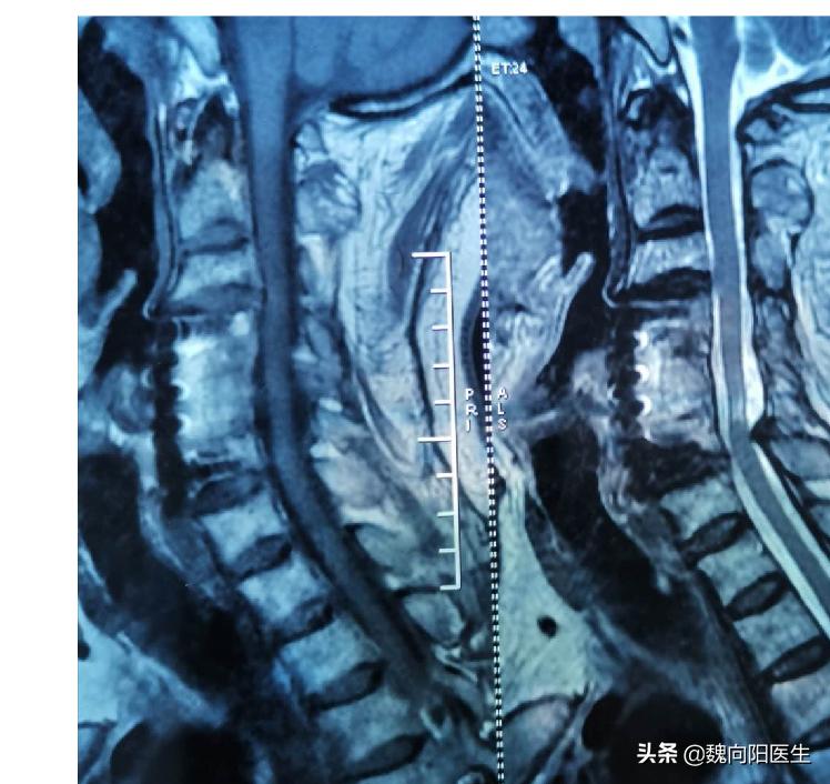 耳眩晕是什么疾病,眩晕常见疾病之梅尼埃