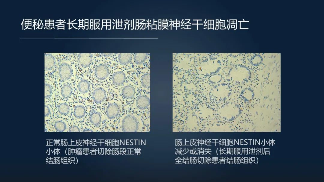 一招调理肠道改善便秘,肠道水疗治便秘有效吗