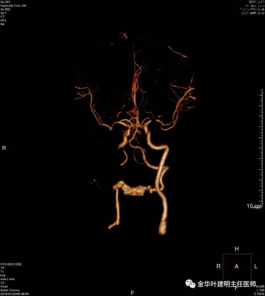 左肺下叶恶性病变,左肺上叶和下叶都有血管畸形