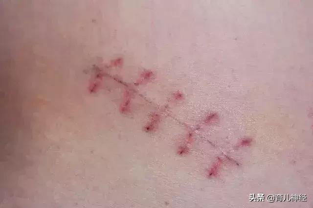 顺产撕裂与侧切有什么区别,顺产撕裂和侧切的区别是什么