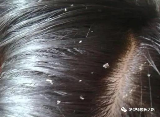 头皮屑的真正原因,头皮屑基础了解