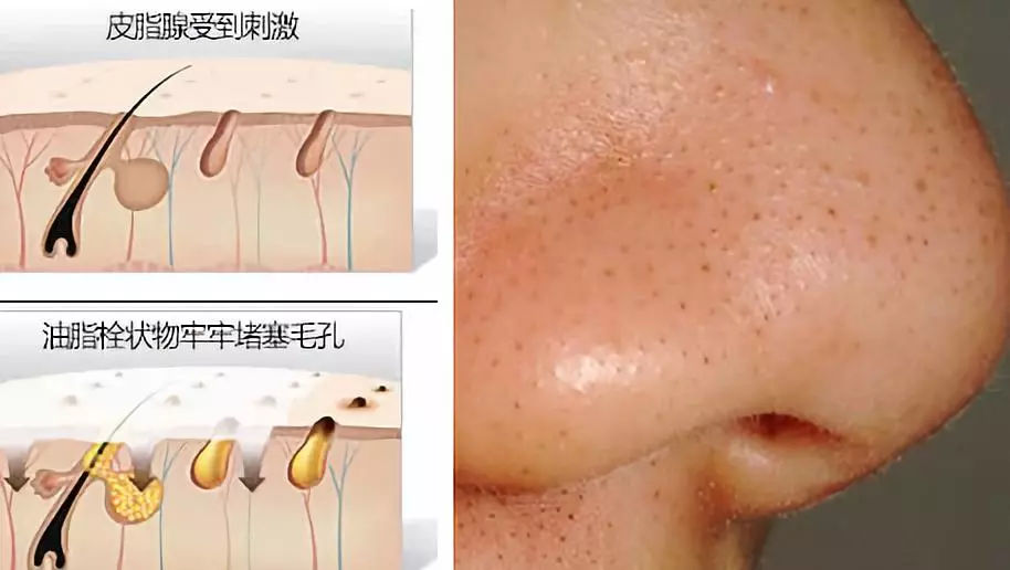 小气泡清洁推荐去黑头收缩毛孔,小气泡去黑头会让毛孔越来越大吗