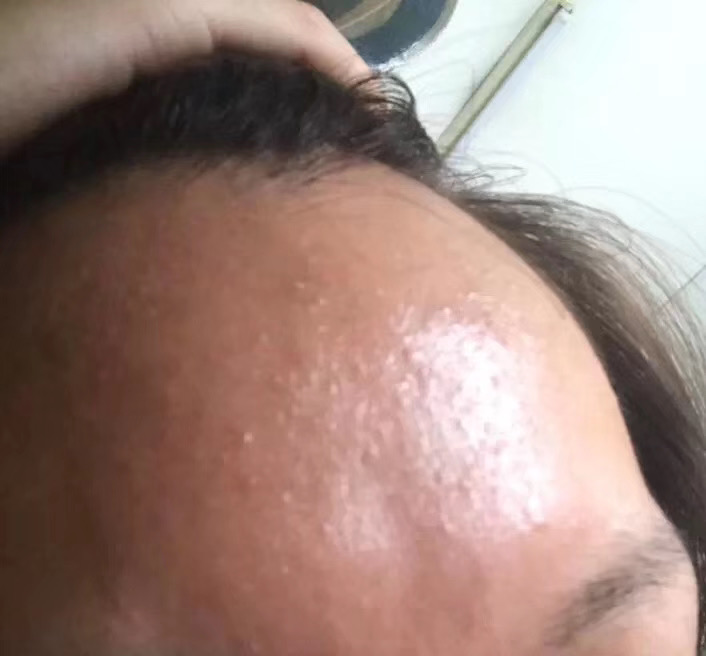 额头上的闭口怎么在家祛除,额头上的闭口怎样去除