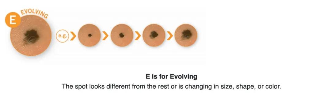 宝宝刚长出来的痣怎么消除,婴儿先天的痣容易癌变