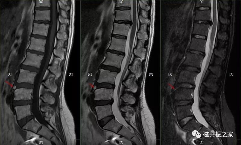 腰椎有哪些病变,腰椎病变有几种
