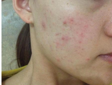 脸上长痘是身体原因还是皮肤原因,脸上长痘可能是什么病引起的