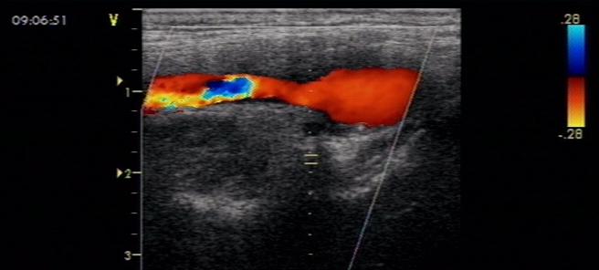 颈动脉斑块有哪些症状和危害,颈动脉有斑块能搓揉吗