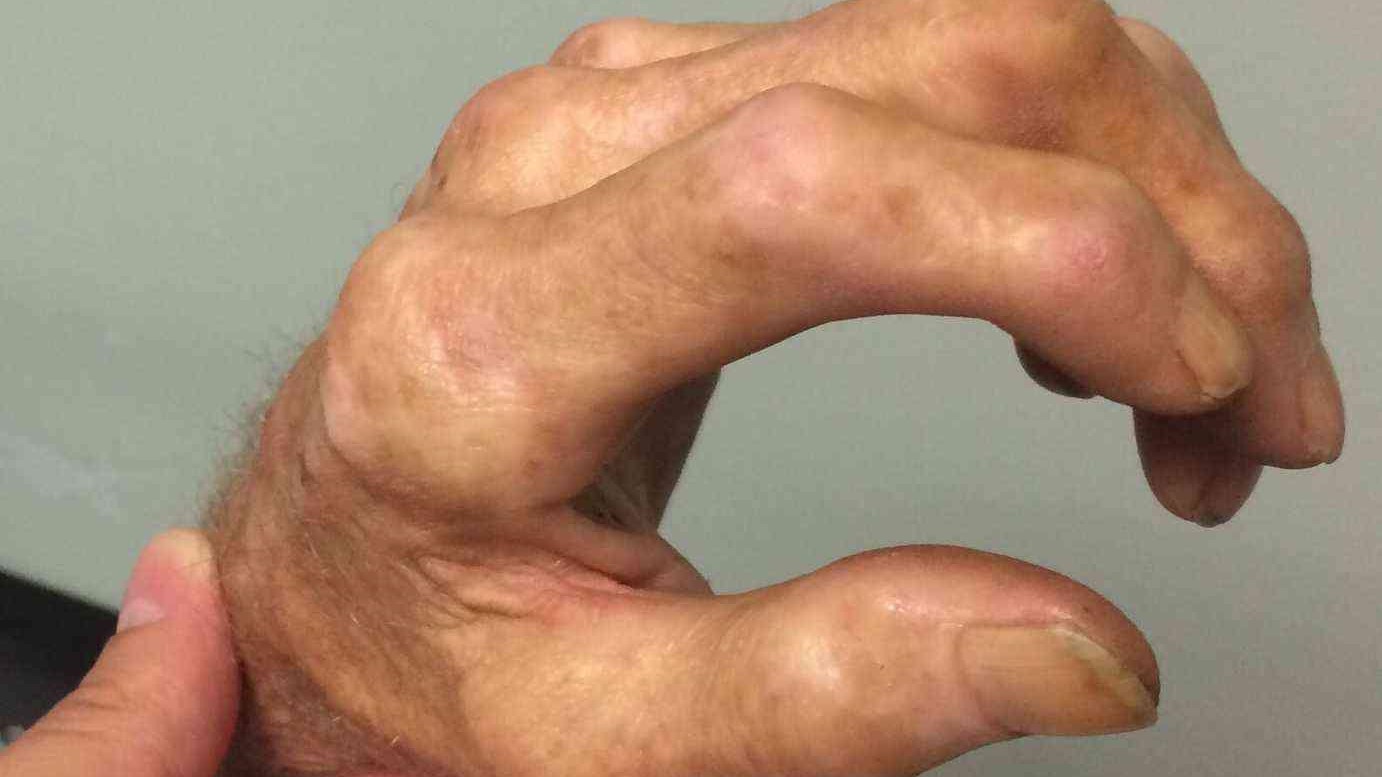 白癜风多大年龄并发症就出来了,白癜风伴随着哪几种常见并发症