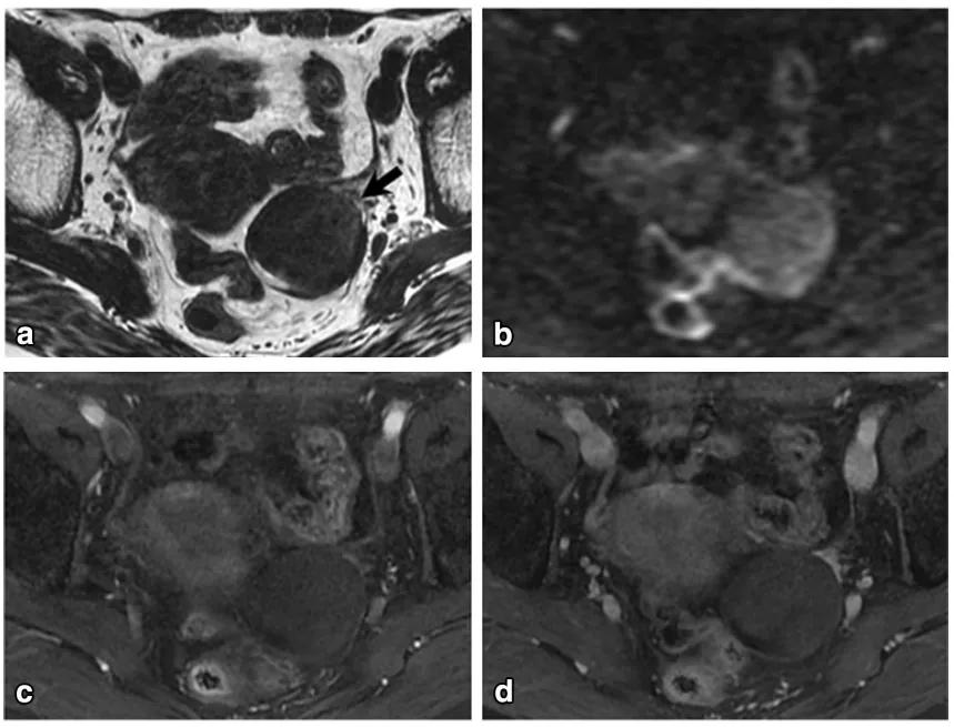 卵巢实性为主肿瘤，这13种你都想到了吗？