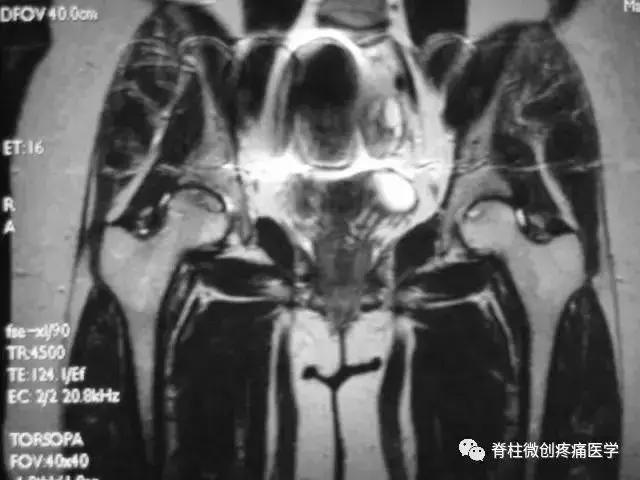 早期股骨头坏死核磁共振怎么看,股骨头坏死磁共振表现及分期